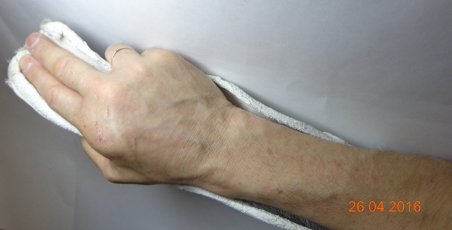Рука в гипсе с двуперстным сложением